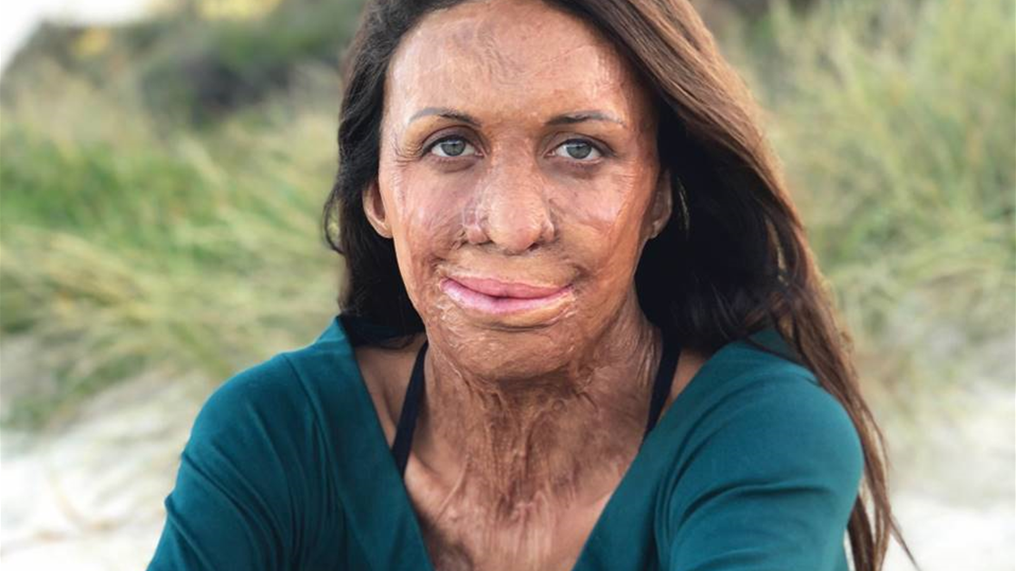 Histoire inspirante Turia Pitt : une femme de curage